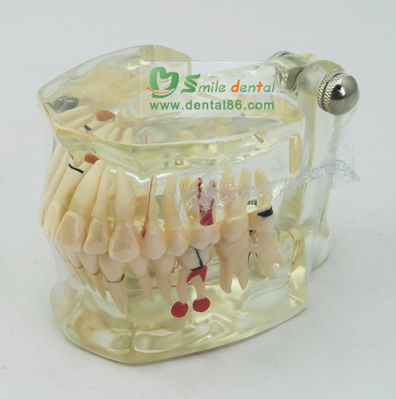 Pathology Model with a tooth missing