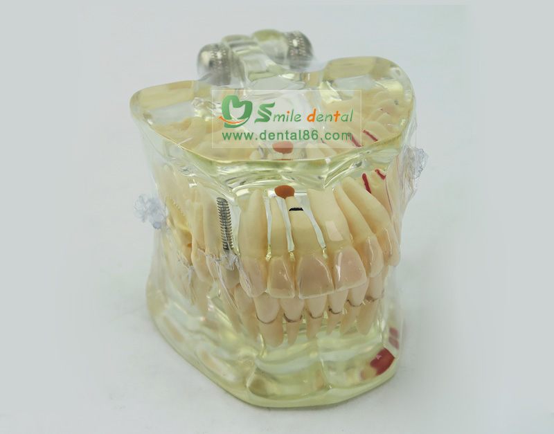 Pathology Model with a tooth missing
